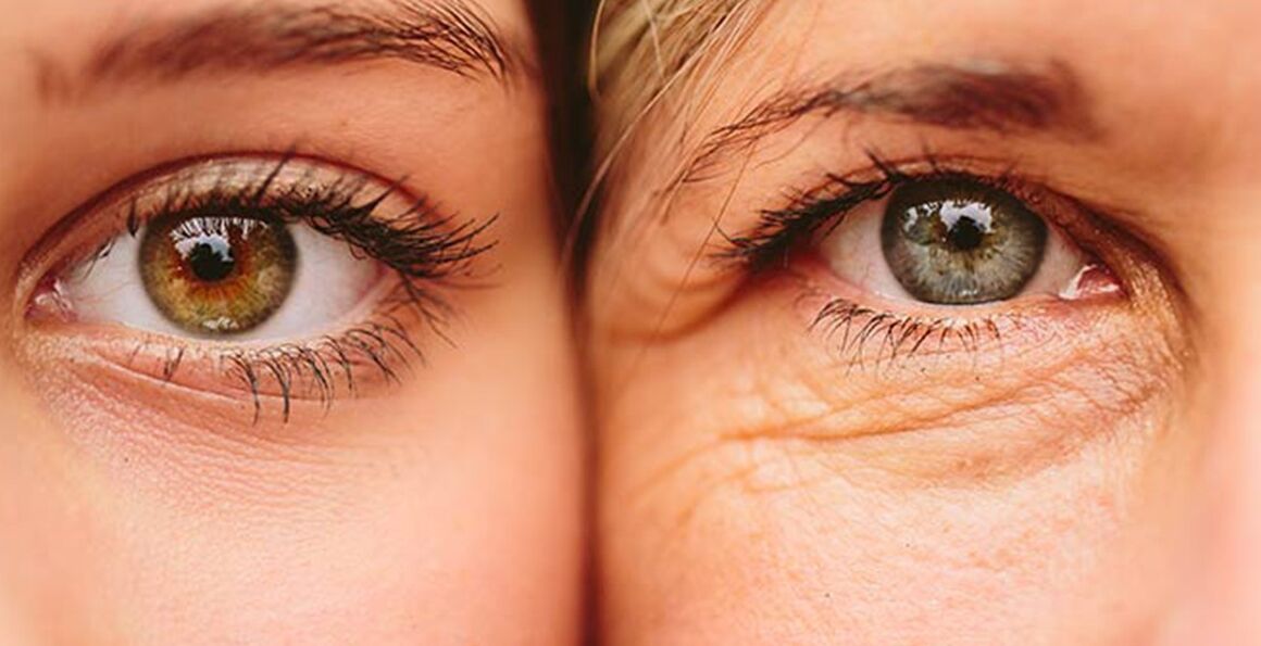 两名不同年龄女性眼周皮肤老化的外部迹象